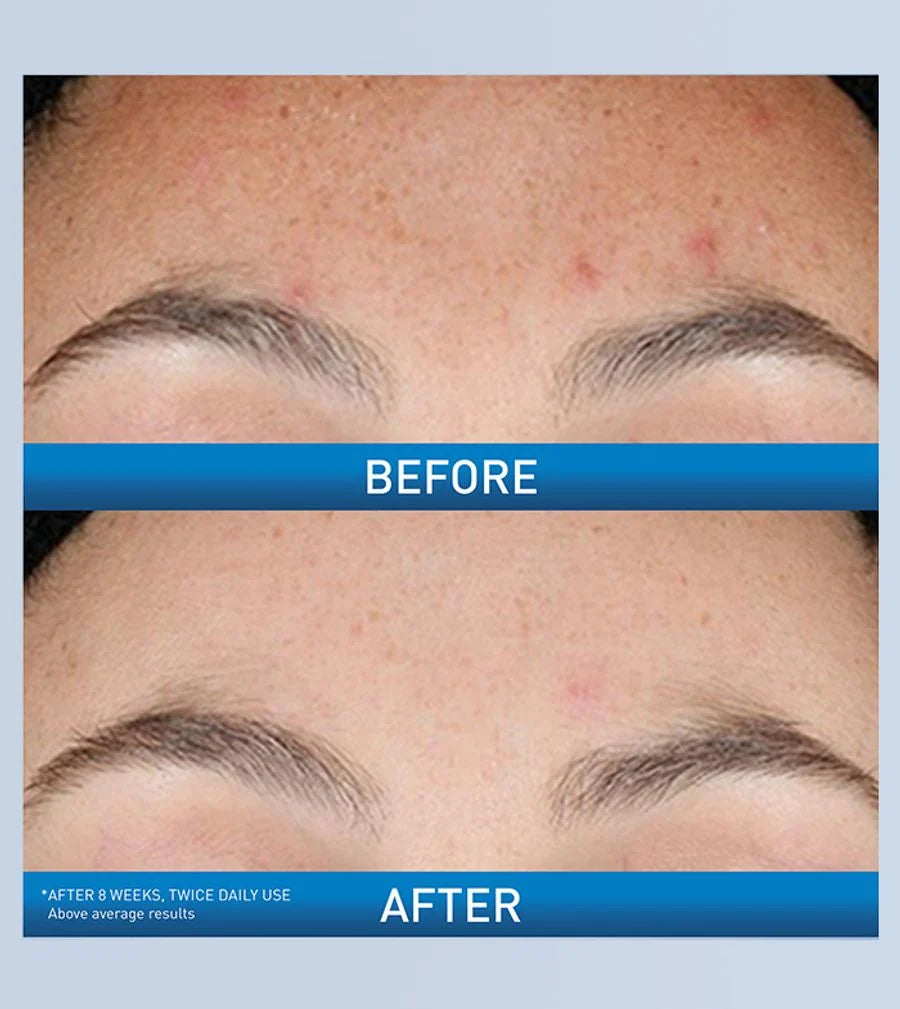 CeraVe Resurfacing Retinol Serum 30ml | Retinol Face Serum for Post-Acne Marks, Pores & Smoother Skin